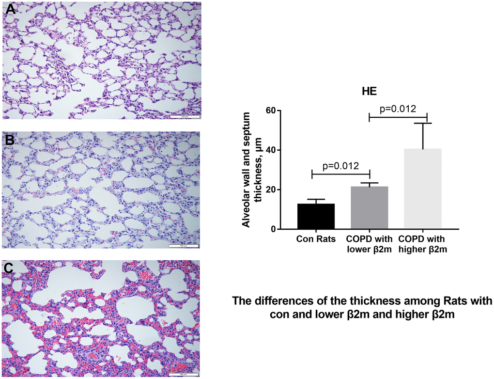 HE staining of lung tissue from rats. (A–C) Representative image of HE staining of lung tissue from control rats, COPD rats with lower β2M and COPD rats with higher β2M, respectively. The right panel shows quantification of alveolar wall and septum thickness in control rats, COPD rats with lower β2M and COPD rats with higher β2M. P