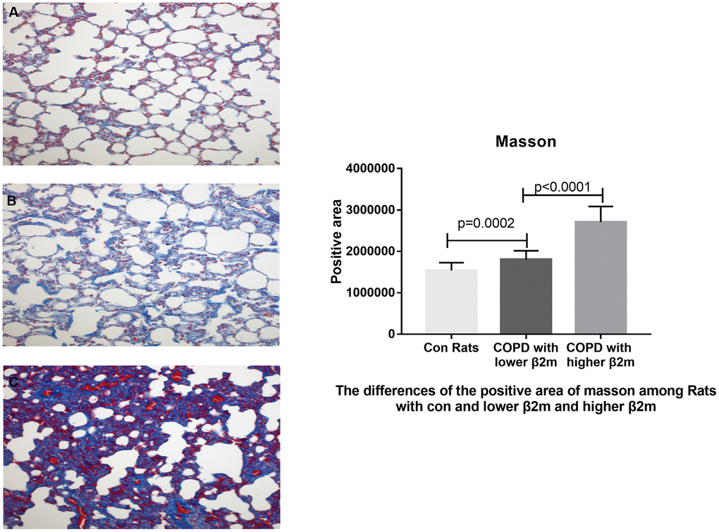 Masson's trichrome staining of lung tissue from rats. (A–C) Representative image of Masson's trichrome staining of lung tissue from control rats, COPD rats with lower β2M and COPD rats with higher β2M, respectively. The right panel shows Masson staining positive area in control rats, COPD rats with lower β2M and COPD rats with higher β2M. P