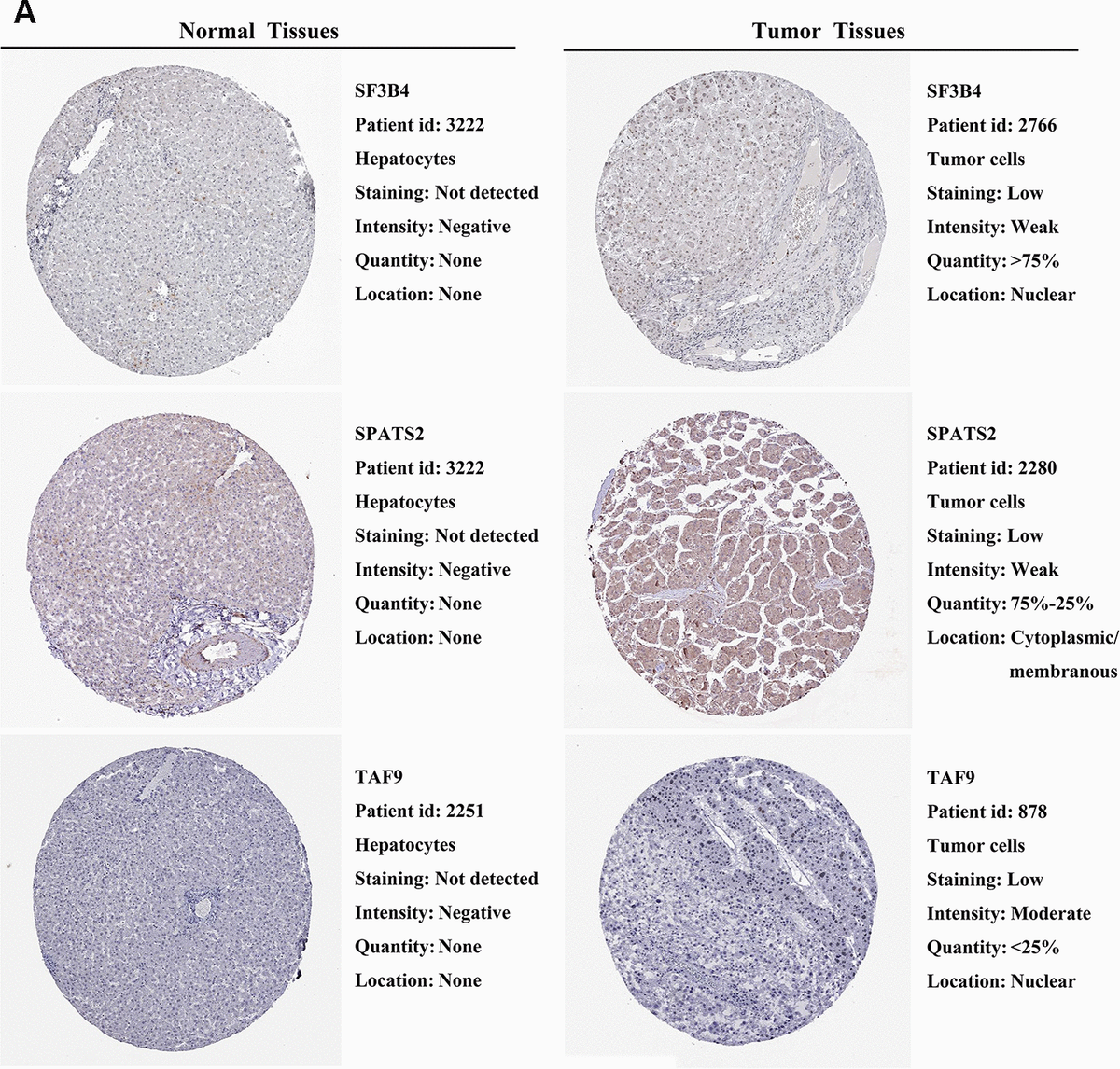 Validation of prognostic RBP expression in the HPA database. (A) Representative immunohistochemical staining of HCC primary tumor tissues and normal liver tissues.