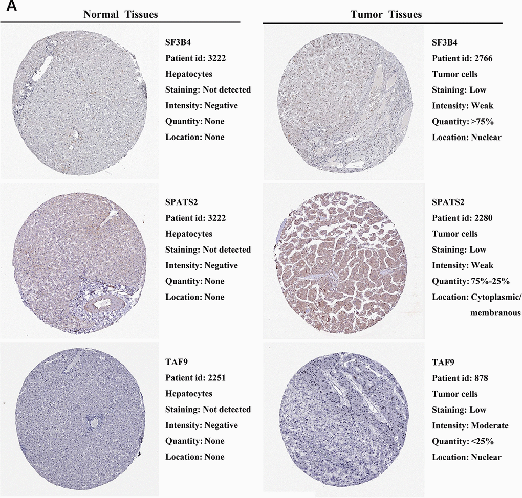 Validation of prognostic RBP expression in the HPA database. (A) Representative immunohistochemical staining of HCC primary tumor tissues and normal liver tissues.
