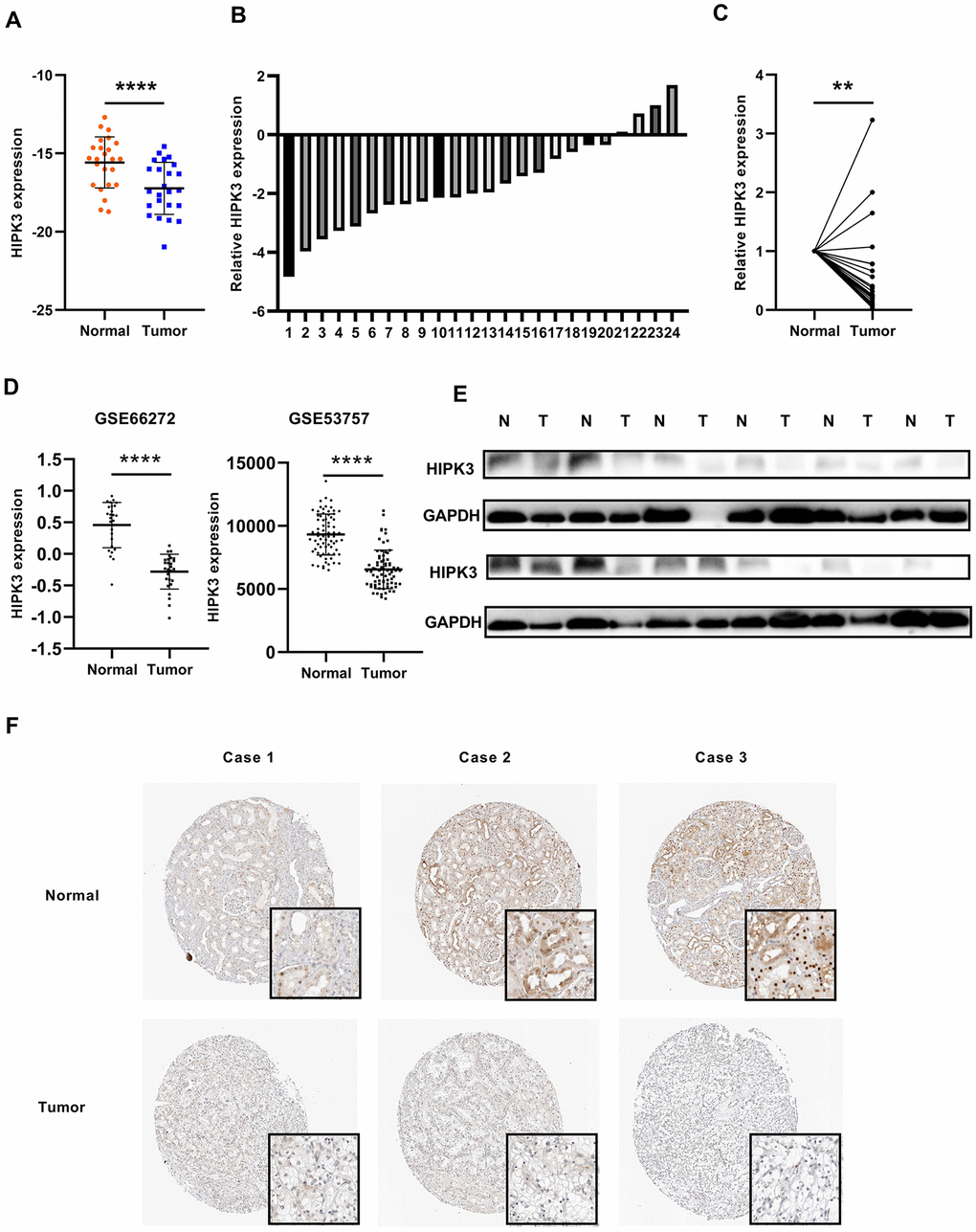 HIPK3 is downregulated in ccRCC tissues. (A, B) Gene expression levels of HIPK3 in renal cancer tissues. (C) Relative HIPK3 expression was downregulated in renal cancer tissues. (D) Validation of HIPK3 expression in renal cancer with Gene Expression Omnibus (GEO66727, GEO53757). (E) IHC analyses of HIPK3 expression in ccRCC tissues and paracancer tissues. **P