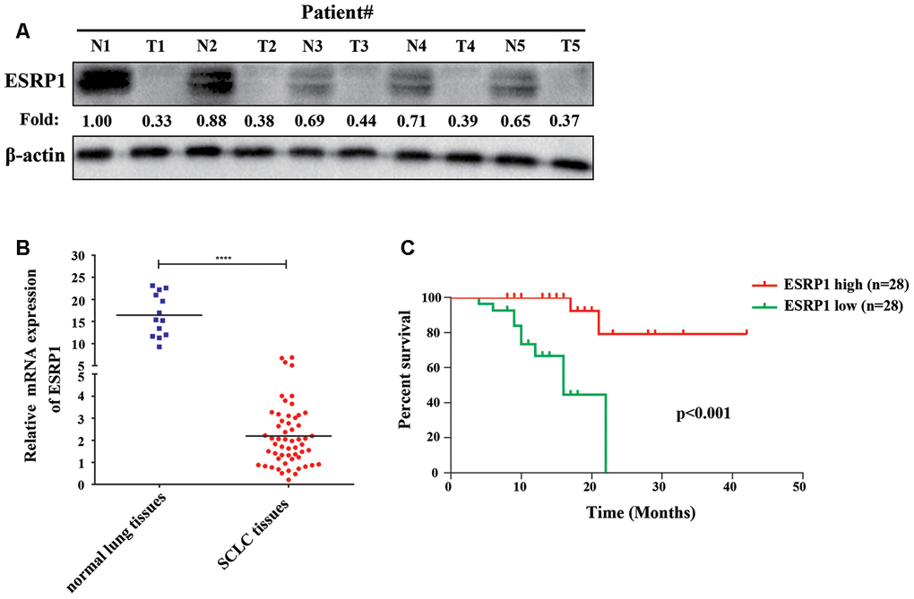 ESRP1 positively correlates with overall survival. (A) ESRP1 levels from five paired SCLC tumors (T) and normal (N) tissues were analyzed by western blotting. (B) ESRP1 mRNA levels in SCLC tissues and adjacent noncancerous lung tissues. (C) Kaplan–Meier analyses of the correlations between ESRP1 mRNA level and overall survival in SCLC patients. *, pp p p 