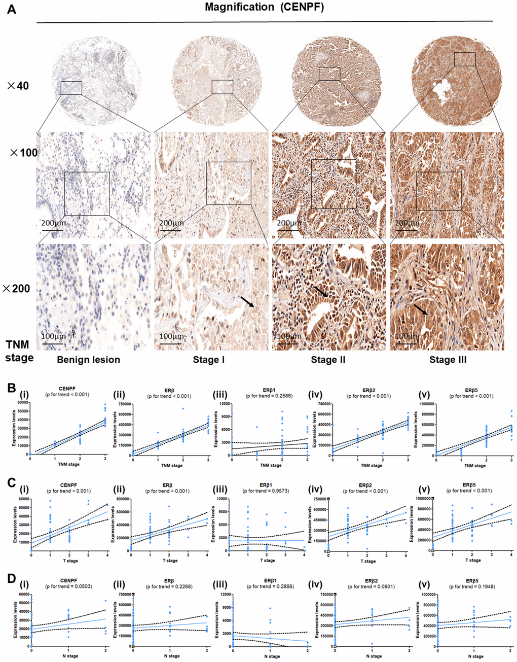 Expression of CENPF, ERβ, ERβ2 and ERβ5 are associated with T stage and TNM stage in LUAD patients. (A) Tissue microarray (TMA) was used to analyze the expression of CENPF in benign lung lesions and different TNM staging tissues of LUAD. The magnification of each slice is 40×, 100×, 200× in order. (B–D) Analysis of the relationship between the expression of CENPF, ERβ, ERβ1, ERβ2 and ERβ5 and the TNM staging or T stage or N stage of LUAD. The corresponding P value is marked above the picture.