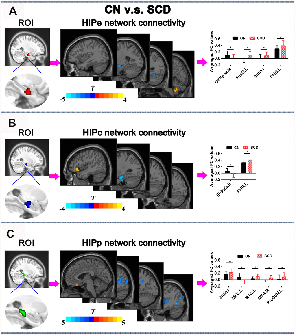 Differences in HIPsub functional connectivity between SCD subjects and CN before rTMS treatment after controlling for age, sex, education, ITV, and FD (p  405 mm3. (A) HIPe-subregion and different brain regions of the HIPe functional connectivity between CN and SCD subjects. The bar chart shows the quantitative comparison of functional connectivity in these regions. (B) HIPc-subregion and different brain regions of the HIPc functional connectivity between CN and SCD subjects. The bar chart depicts the quantitative comparison of functional connectivity in these regions. (C) HIPp-subregion and different brain regions of the HIPp functional connectivity between CN and SCD subjects. The bar chart indicates the quantitative comparison of functional connectivity in these regions. * PTFCE-FDR