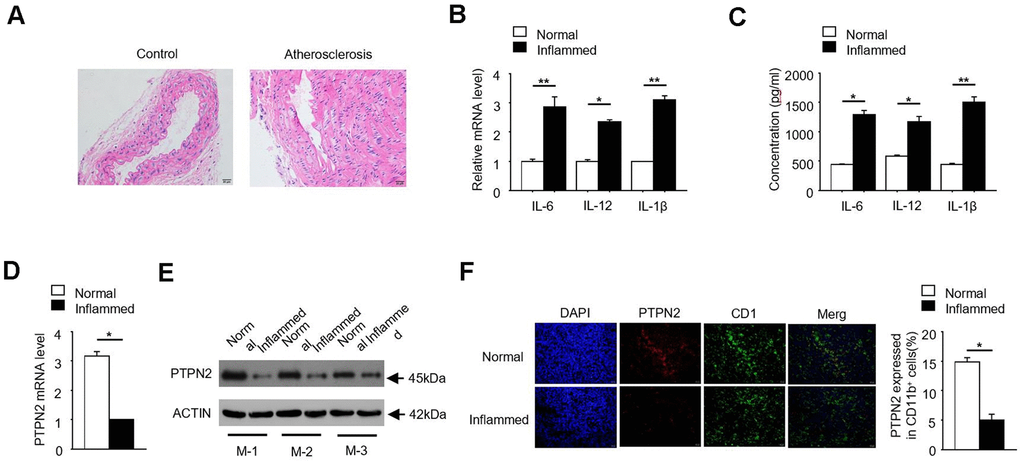 PTPN2 is negatively correlated with inflammation in ApoE-/- mice. (A) Photomicrograph of atherosclerotic lesions stained with Hematoxylin-Eosin. (B) The mRNA level of IL-6, IL-12 and IL-1β in macrophages from normal and inflamed aortic roots were analyzed by qRT-PCR. (C) ELISA assay analysis the production of IL-6, IL-12, IL-1β in macrophages from normal and inflamed fictions. (D) PTPN2 mRNA level in normal and inflamed aortic roots were analyzed by qRT-PCR. (E) IB analysis PTPN2 expression from three different ApoE-/- mice. M-1, M-2, M-3 were three different ApoE-/- mice. (F) Confocal microscopy analysis CD11b and PTPN2 in normal and inflamed aortic roots in ApoE-/- mice. Data is representative of at least three independent experiments and are presented as mean ± SD. ns, not statistically significant; *, P 