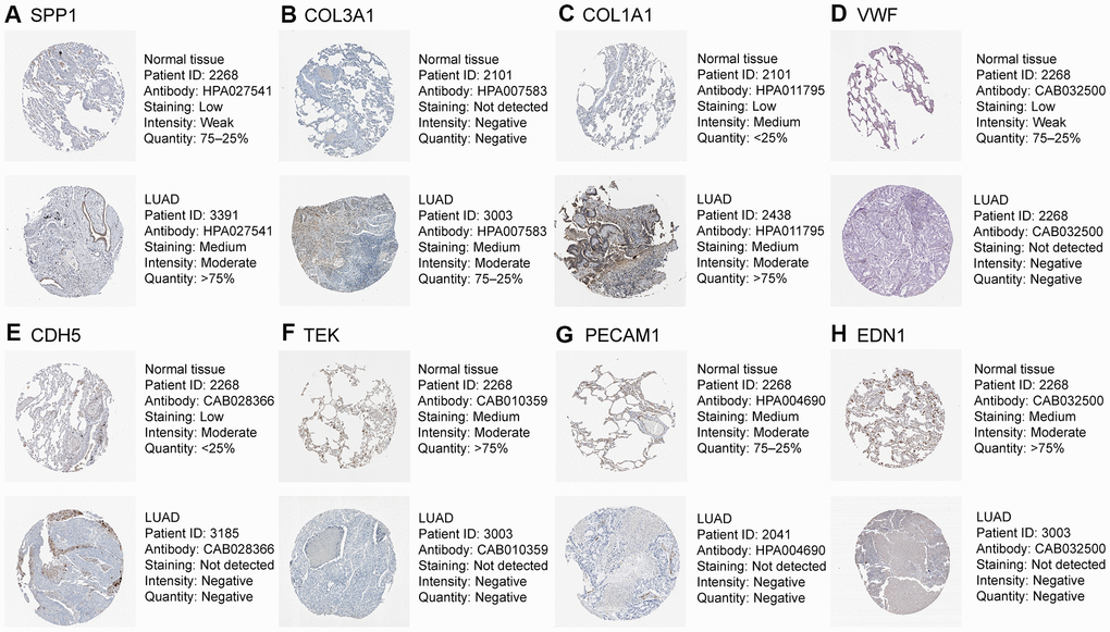 Validation of eight hub genes using The Human Protein Atlas database. Expression of (A) SPP1, (B) COL3A1, (C) COL1A1, (D) VWF, (E) CDH5, (F) TEK, (G) PECAM1, and (H) EDN1.