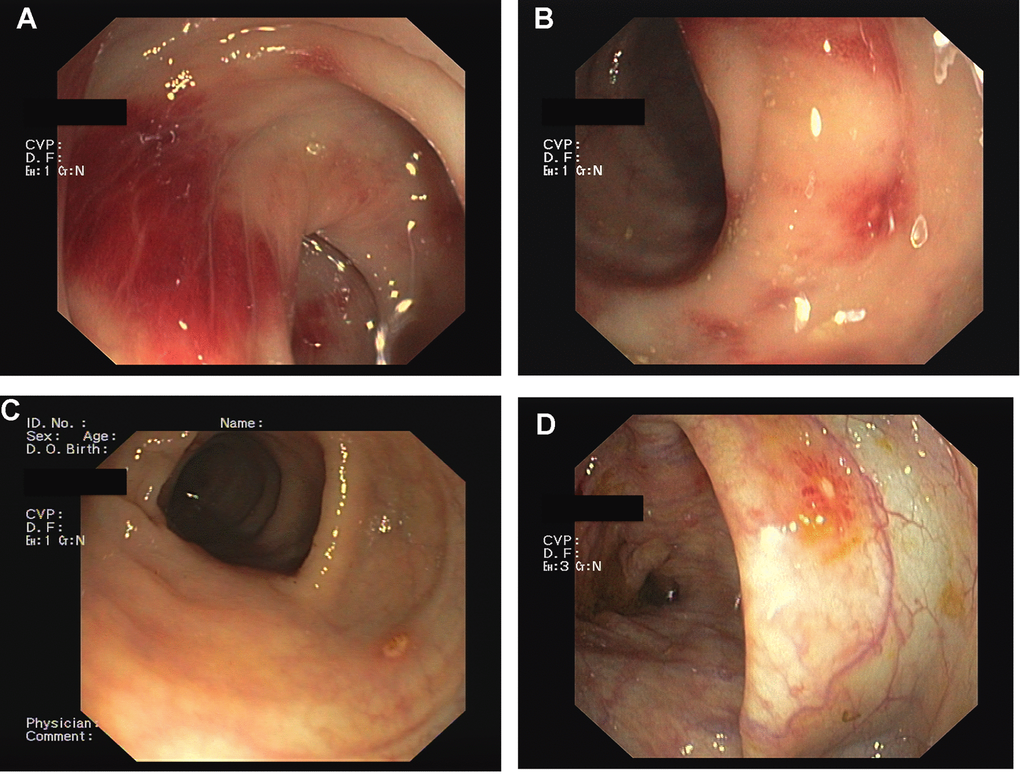Mycophenolic Acid colitis. Endoscopic Findings. Colonoscopy demonstrated the presence of severe hyperemia to the right colon (A, B), with erosion of the colonic mucosa (C, D).