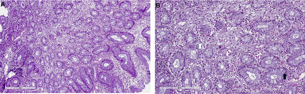 Mycophenolate mofetil colitis. Histological examination. Biopsy of right colon: (A) severe eosinophils, lymphocytes and plasma cells infiltrate (10x), with (B) severe cryptitis (20x, white arrow) and cell apoptosis (black arrow).
