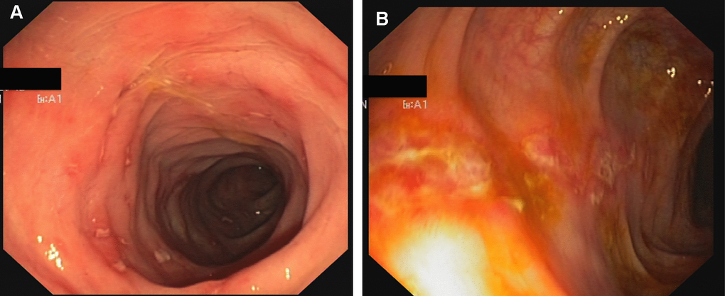 Crohn-like colitis. Endoscopic findings. Multiple erosions and hyperemia of the mucosa of rectum (A) and sigma (B).