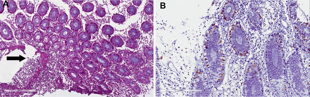 Crohn-like colitis. Histological features. (A) Irregular, severe eosinophils, neutrophils and plasma cells infiltrate in the submucosal layer (arrow). (B) Proliferation index Ki67 in the crypt, without apoptosis. Elevated Ki67 suggests regenerative activity as a consequence of crypt injury (cryptitis).