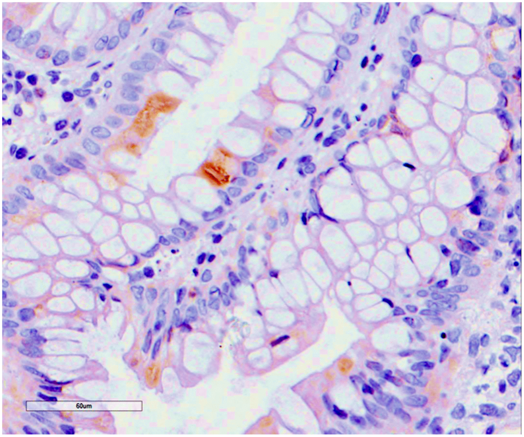 Cytomegalovirus colitis. Histological findings. Positivity for early cytomegalovirus antigen on immunochemistry.