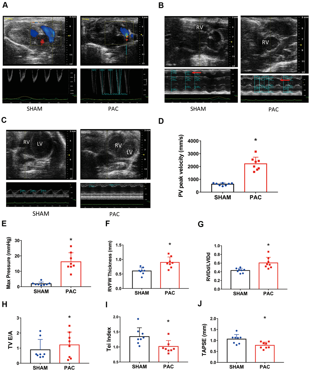 RNA interactions in right ventricular dysfunction induced type II 