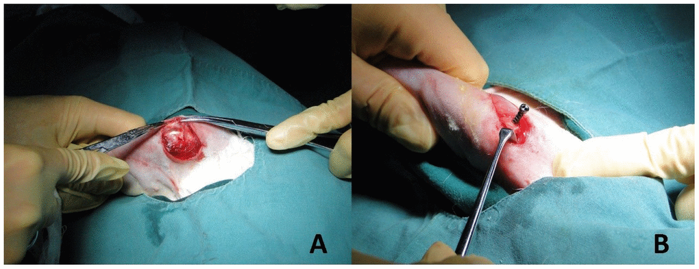 Establishment of implant model. (A) The deltoid muscle of the rabbit was bluntly dissected to reveal the greater tubercle of humerus. (B) Titanium alloy screws with different pore structures (trabecular pore structure in the study group and classical pore structure in the control group) were drilled in the long axis of the distal humerus approximately 120 degrees. The implant models of titanium alloy with different spatial structures of proximal humerus were established.