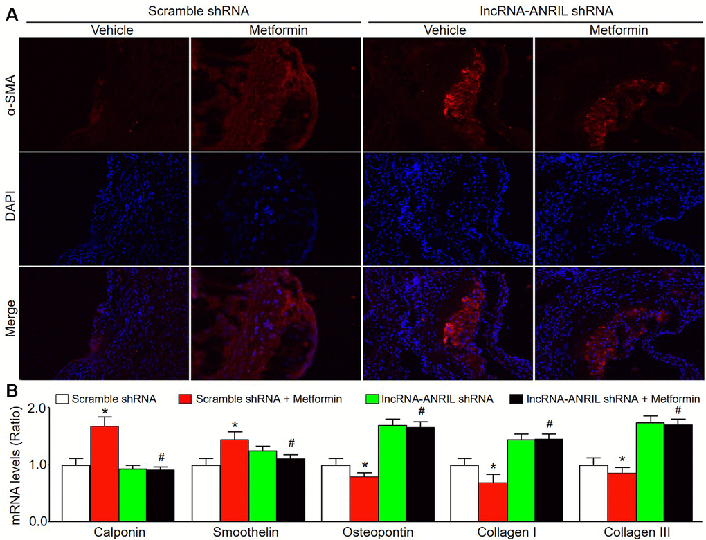 Adenovirus-mediated knockdown of lncRNA-ANRIL prevents the effects of metformin on VSMC phenotype switch in Apoe−/− mice. The animal experimental protocol was shown in Figure 5A. (A) The morphology of VSMC in atherosclerotic plaque was determined by immunofluorescence analysis of α-SMA. (B) The mRNA levels of the markers of VSMC phenotype switch, including calponin, smoothelin, osteopontin, collagen I, and collagen III in aortic tissue were measured by real-time PCR. N is 10-15 in each group. *Pvs. scramble shRNA alone. #P