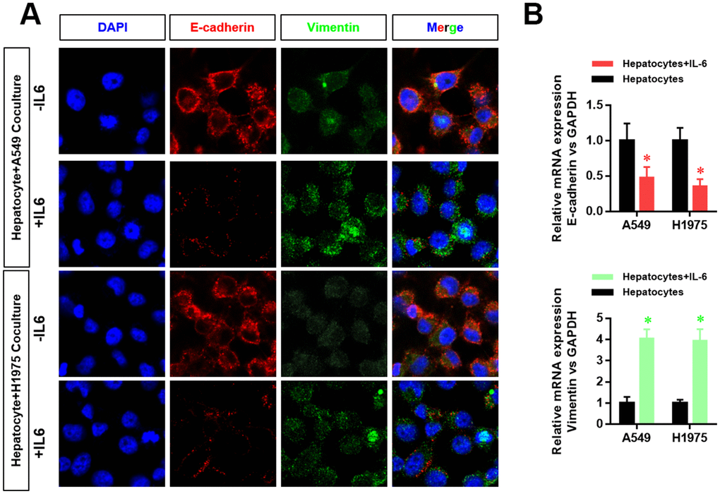 The hepatic inflammatory microenvironment promoted the epithelial–mesenchymal transition (EMT) of lung adenocarcinoma cells. (A) The expression level of E-cadherin and vimentin in A549 and H1975 cells was detected by laser confocal scanning microscopy. (B) Changes in CDH1 and VIM mRNA expression in A549 and H1975 cells were detected by real-time PCR (*P