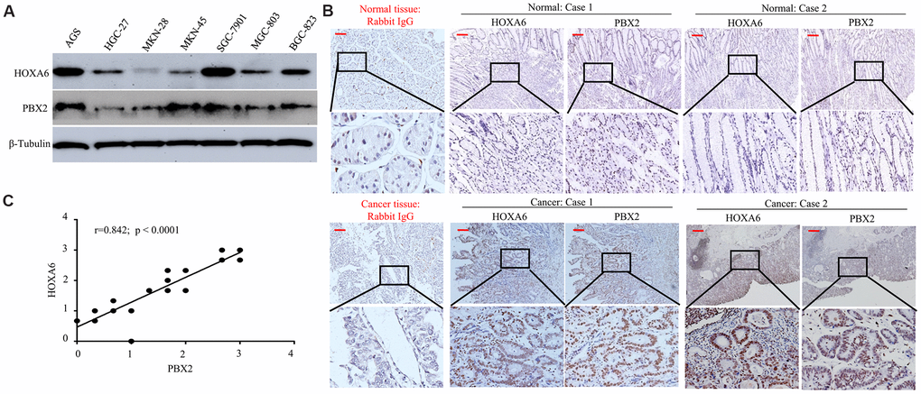 The positive expression of HOXA6 correlated with PBX2 expression. (A) Western blot analysis was is used to determinate the expression of HOXA6 and PBX2 in GC cell lines. (B) Representative IHC images of HOXA6 and PBX2 in GC (n =23) and their matched adjacent tissues following serial sectioning. The first antibody used for normal rabbit IgG as an isotype control. (C) Spearman correlation analysis of HOXA6 and PBX2 protein levels in GC tissue. Scale bars in B represent 50 μm.