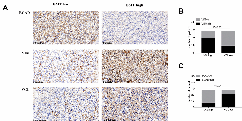 The expression of VCL was positively correlated with EMT (A) IHC analysis of VIM, ECAD, and VCL in 56 human gastric cancer specimens (200X). (B) Correlation between VIM and VCL expression. (C) Correlation between ECAD and VCL expression.