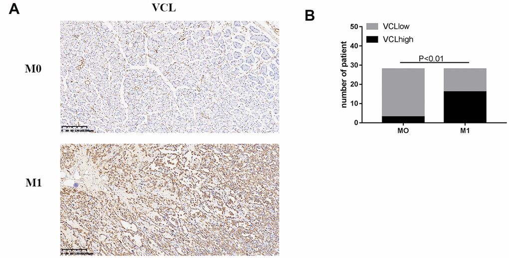 The expression of VCL was positively correlated with M1 (A) IHC analysis of VCL in 56 human gastric cancer specimens (200X) of M0 and M1. (B) Correlation between M1 and VCL expression.