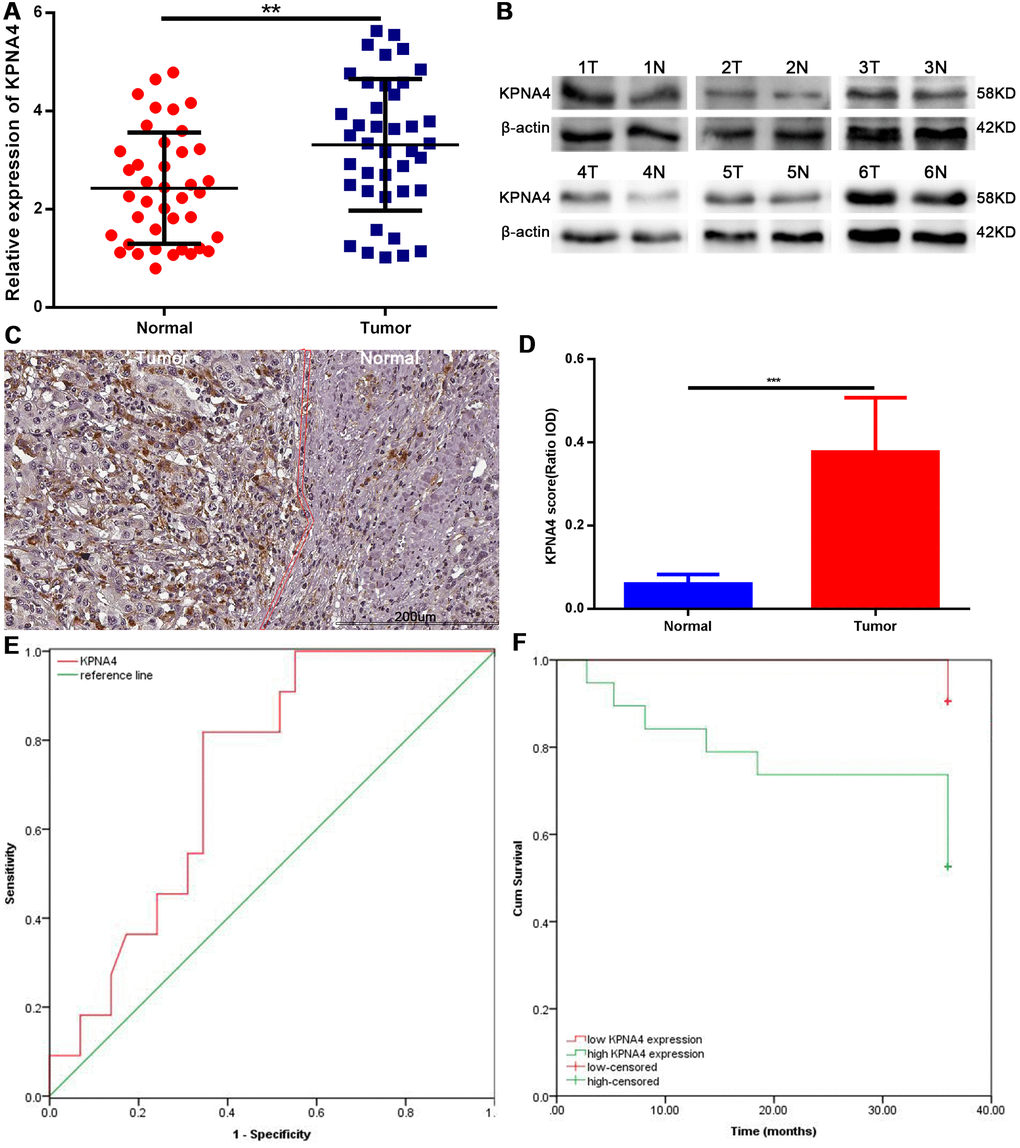 Expression levels of KPNA4 and prognostic values in HCC patients. (A) KPNA4 mRNA level was increased in HCC tissues compared with normal tissues as measured by qRT-PCR. (B) KPNA4 protein level was increased in HCC tissues compared with normal tissues as measured by western blot. (C) KPNA4 expression by immunohistochemistry staining. (D) Semi-quantitative analysis of KPNA4 protein expression between cancerous specimens and non-cancerous parts. (E) ROC of KPNA4 level in HCC showing that elevated KPNA4 level correlated with HCC incidence. (F) High KPNA4 expression level correlated with poor OS.