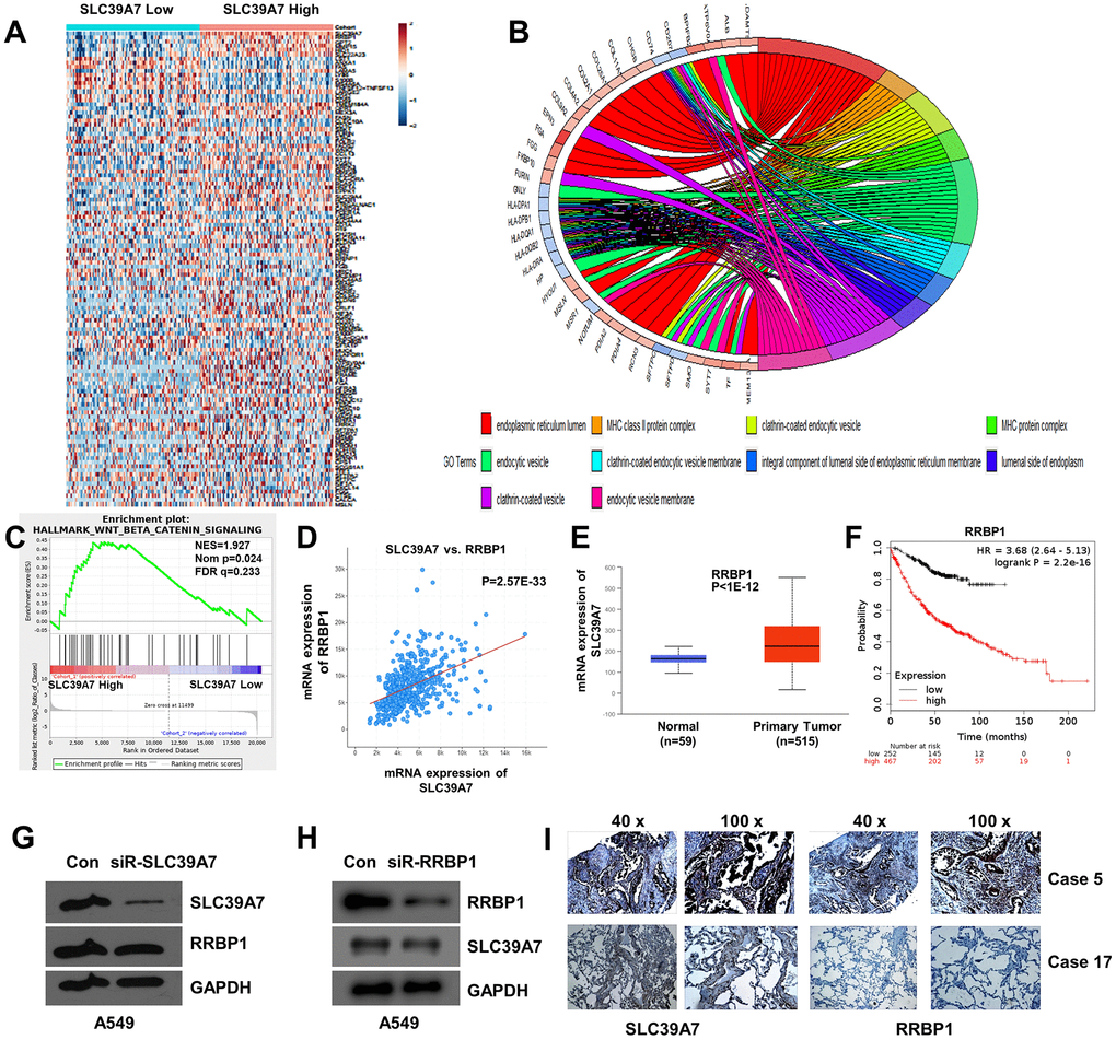GO enriched analysis, GSEA analysis and co-expression analysis of SLC39A7 in lung adenocarcinoma. (A) Heat-map showed the DEGs of SLC39A7. (B) GO enriched analysis (CC) for SLC39A7. (C) GSEA of Wnt/β-catenin signaling pathway. (D) Co-expression of SLC39A7 and RRBP1 by using cBioportal database. (E) RRBP1 expression of mRNA in LUAD tissues and relative normal tissues in Ualcan database. (F) Kaplan-Meier plotter was used to evaluate prognostic value (OS) of RRBP1 in lung adenocarcinoma. A549 cells were transfected with a control siRNA or siRNA-SLC39A7 (G)/ RRBP1 (H). Western blotting was performed to detect the expression of SLC39A7 and RRBP1. (I) Immunohistochemistry assays were performed to detect expression and distribution of SLC39A7 and RRBP1 proteins in lung adenocarcinoma tissues. DEG, differentially expressed genes; GSEA, Gene Set Enrichment Analysis; RRBP1, ribosome binding protein 1; SLC39A, solute carrier family 39.