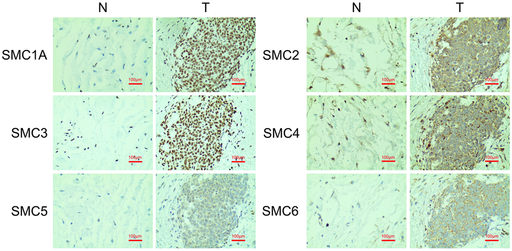 The Expression of SMCs in synovial sarcoma (Immunohistochemistry). N: normal control; T: synovial sarcoma.
