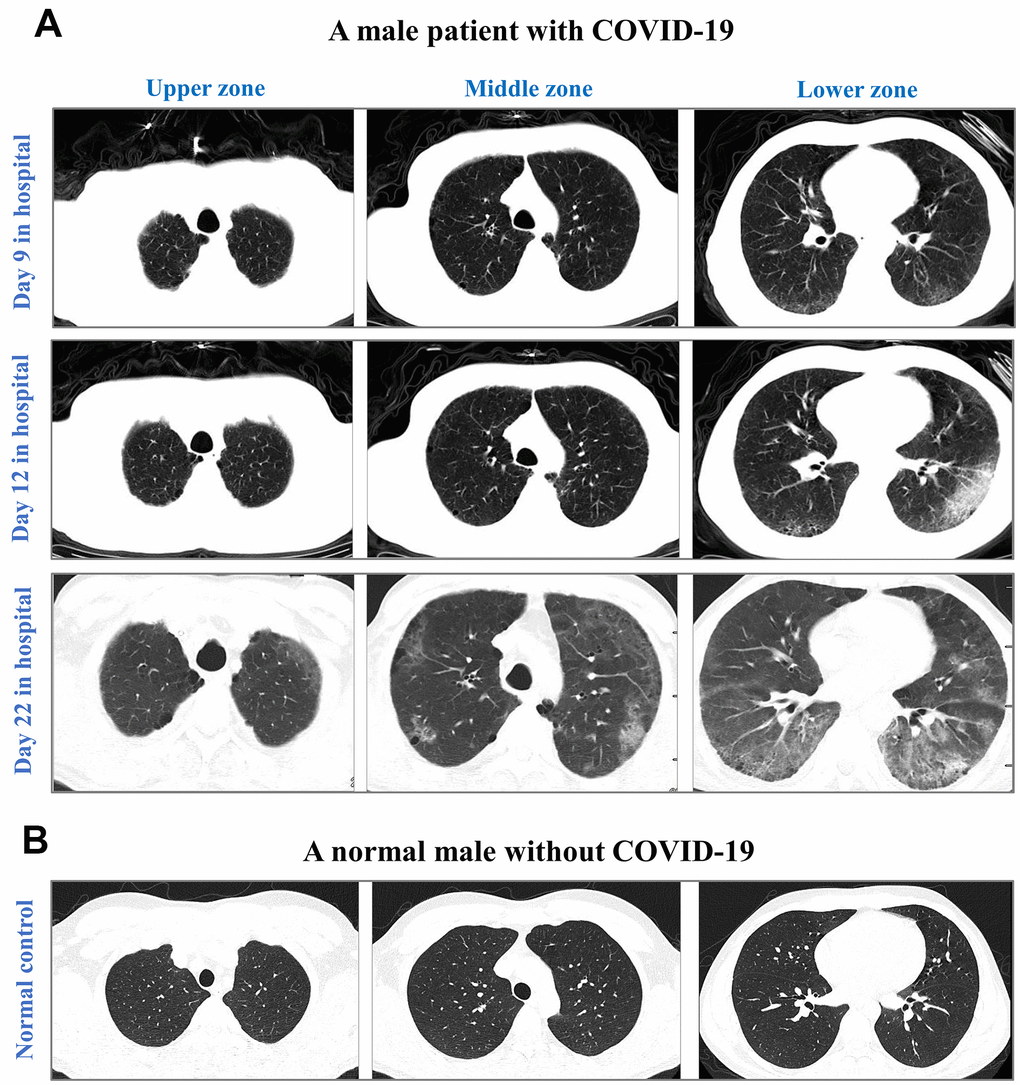 CT images from an elderly male with laboratory-confirmed COVID-19 (A) and a normal male without COVID-19 (B). CT images were illustrated in the upper zone (above the carina), the middle zone (below the carina up to the inferior pulmonary vein), and the lower zone (below the inferior pulmonary vein). After 9-day hospitalization, CT images showed minor ground-glass opacity (GGO) in subpleural areas of the lower left and right lobes in the COVID-19 male. After 12-day hospitalization, CT images showed progressing GGOs and newly-appeared reticulation. The vascular enlargement was observed in the lesion of the lower left lung. A small amount of bilateral pleural effusion was newly developed. After 22-day hospitalization, CT images showed progressing lesion with multiple newly-appeared GGO in both lungs, predominantly located in subpleural areas of lower lobes. Bronchiectasis of the anterior internal basal segment of the left lower lung was visible. Progressing bilateral pleural effusion was identified. The patient passed away after 24 days of hospitalization in The First Hospital of Changsha.