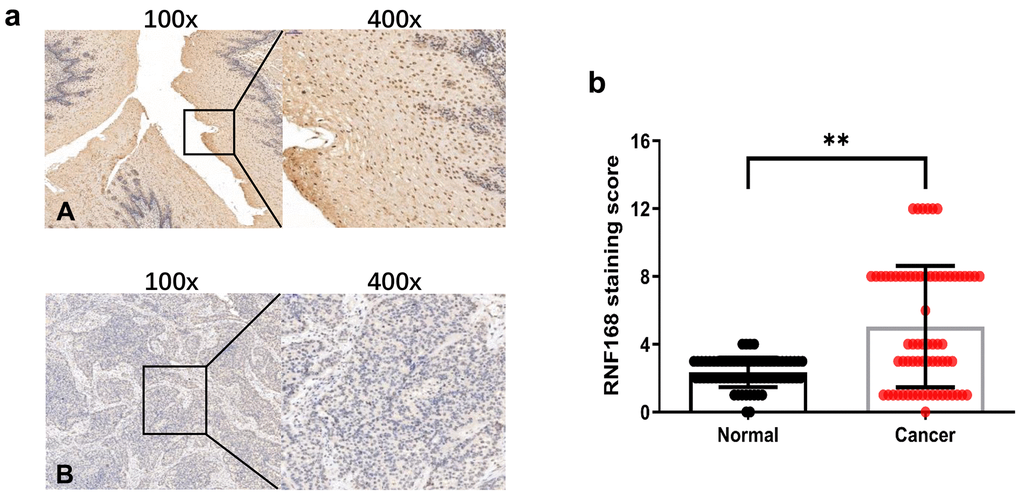 (a) Representative results of immunohistochemical staining for RNF168 in human ESCC (A) Cancer tissue with high RNF168 expression; (B) Cancer tissue with low RNF168 expression); (b) RNF168 protein expression scores for esophageal squamous cell carcinoma tissues and matched adjacent normal tissues (** P