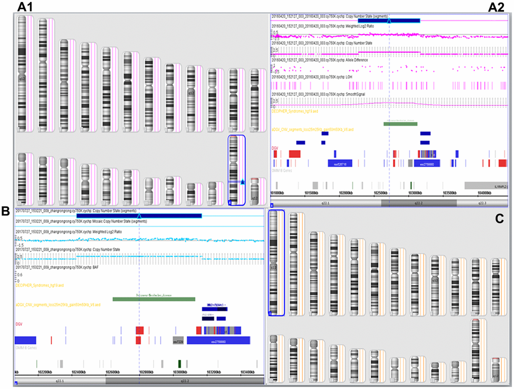 SNP array results. SNP-array analysis showed the proband (A1, A2) and his mother (B) to be 46,XY.arr[GRCh37]Xq22.1q22.2 (102,429,064-103,168,721)x2 and arr[GRCh37] Xq22.1q22.2(102,429,064-103,168,721)x3, respectively, with a duplicated 740 Kb region (102,429,064-103,168,721) leading to partial disomy of Xq22.1q22.2, which encompassing PLP1 gene, the SNP array results of the boy indicated a diagnosis of PMD. The pregnant mother was proved to be a female carrier of PLP1 duplication, and the male fetus revealed no such duplication (arr[GRCh37] (1-22)x2, (XY)x1) (C, Table 1).