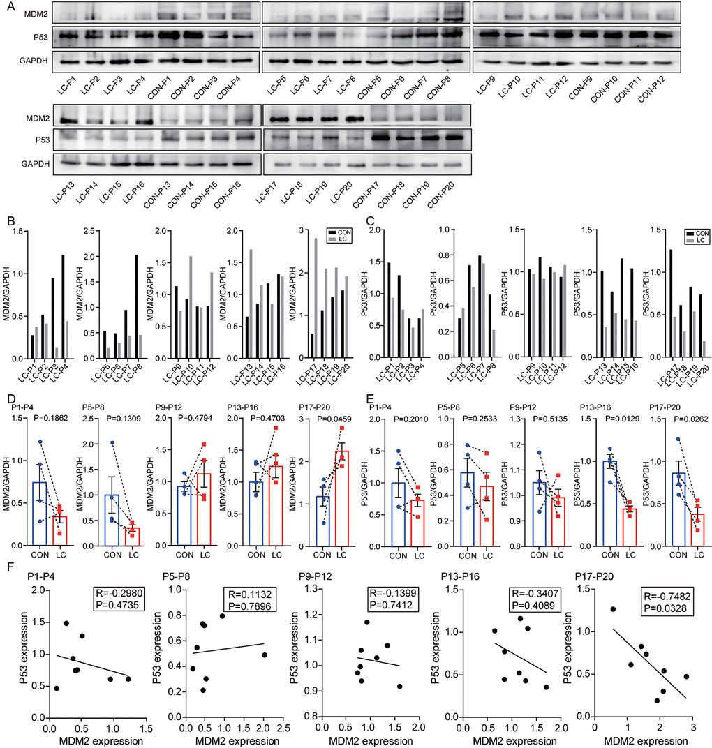 Levels of MDM2 and P53 protein in samples of NSCLC tissues and paired non-cancerous matched tissues. (A) MDM2 and P53 expression in 20 NSCLC tissues compared with paired non-cancerous matched tissues were determined by western blot. (B) The quantification of MDM2 protein was analyzed according to bands in Figure 8A. (C) The quantification of P53 protein was analyzed according to bands in Figure 8A. (D, E) Schematic representation of the expression level of MDM2 and P53 in 20 NSCLC tissues compared with paired non-cancerous matched tissues. (F) Correlation analysis between MDM2 expression and P53 expression via Spearman Rank test.