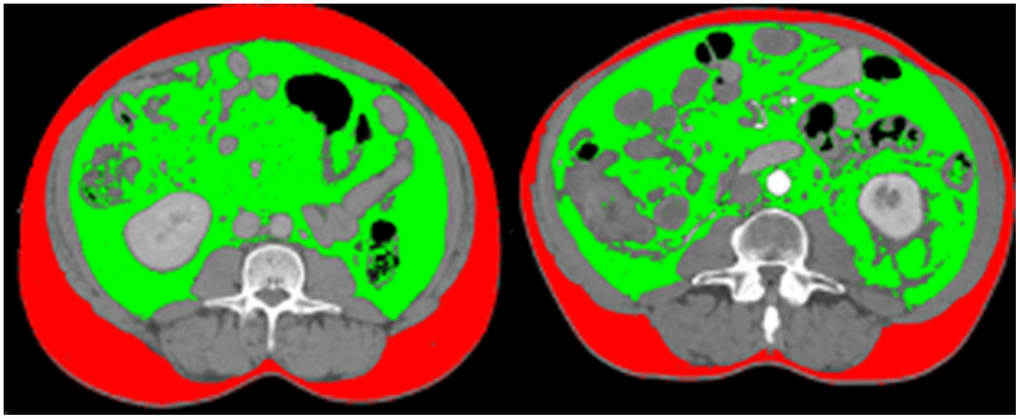 Comparison of visceral obesity of two patients with same BMI. The first patient has lower BMI than the other patient (20.1 kg/m2 vs. 29.3kg/m2), and its VAT/SAT ratio is also lower, which means that patient with lower BMI has less visceral obesity (VAT/SAT ratio: 1.22 vs. 2.48).