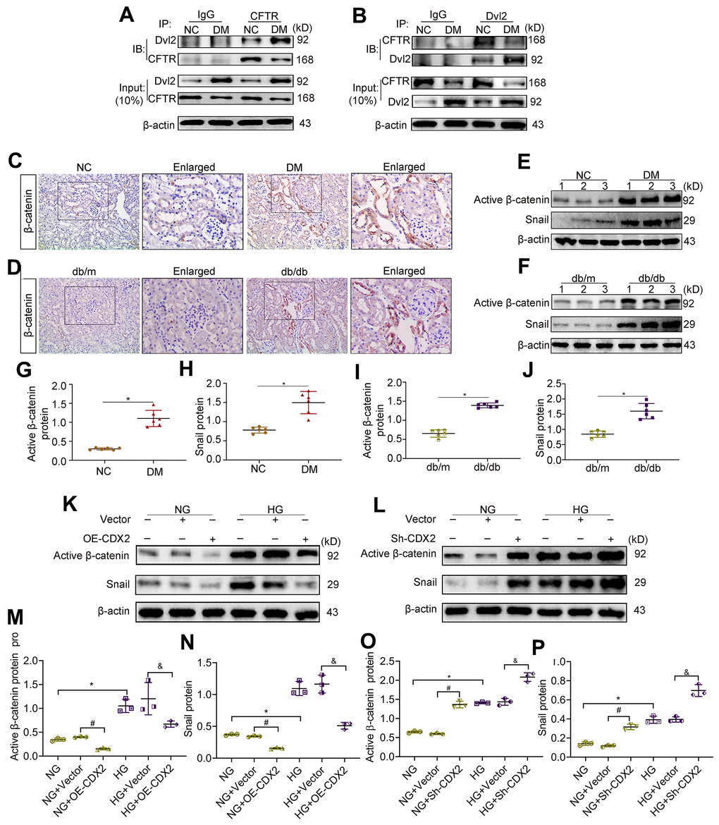 Downregulation of CFTR activates β-catenin and causes renal fibrosis. (A, B) Co-immunoprecipitation assay indicated that CFTR and Dvl2 interacted with each other in vivo. The Input group was a positive control group. In the CO-IP group, the kidney tissue lysates of T1D mice and controls were immunoprecipitated with IgG, anti-CFTR (A) or anti-Dvl2 (B) antibodies, and the resulting immunoprecipitates were blotted (IB) with anti-CFTR and anti-Dvl2 antibodies. The protein samples used for co-immunoprecipitation were normalized to β-actin. (C, D) Immunohistochemical staining of β-catenin in T1D model mice and controls (C), and T2D mice and controls (D). Positive staining (black arrow) (magnification, ×200); enlarged box area (magnification, ×400). (E–J) Western blot bands of Activated β-catenin and Snail in T1D model mice and controls (E), and T2D model mice and controls (F); quantitative data are shown (G–J). n=6; *PK–P) Western blot bands (K, L) and quantitative data (M–P) of activated β-catenin and Snail in non-transfected (NG group, HG group) NRK-52E cells, and NRK-52E cells transfected with Vector (NG+Vector group or HG+Vector group), or CDX2-overexpressing (NG+OE-CDX2 group or HG+OE-CDX2 group) or CDX2-knockdown (NG+Sh-CDX2 group or HG+Sh-CDX2 group) plasmid. Data are mean±SD from three experiments performed independently. n=3; *P#P&P