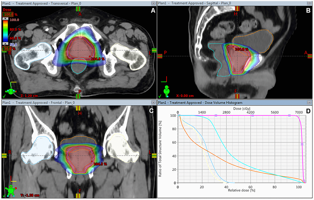 Dose distribution on the transverse (A), sagittal (B) and coronal (C) CT imaging, and DVH (D) of treatment planning of hypofractionated VMAT for patients with prostate cancer. DVH, dose–volume histogram; VMAT, volumetric modulated arc radiotherapy.