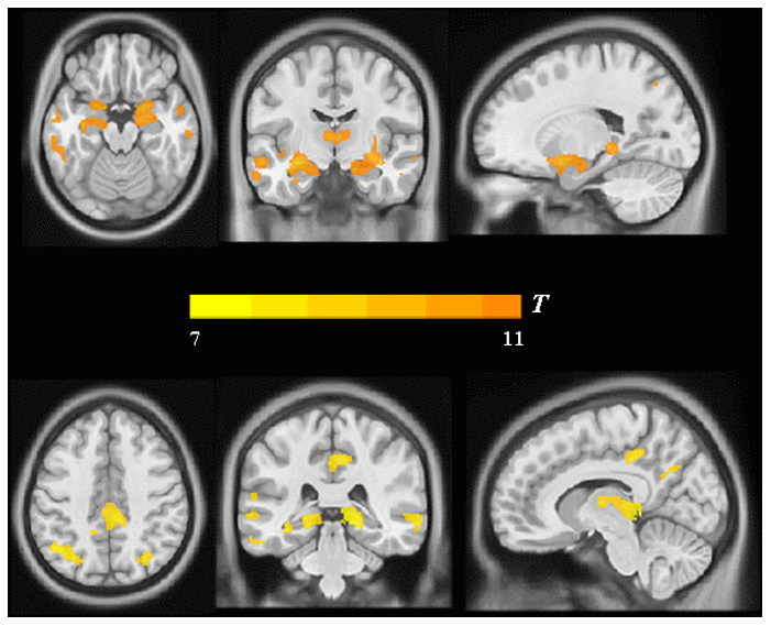 Group differences in VBM analysis between the AD group and the NC group. Significant reduced gray matter volume in AD patients was shown in warm yellows.