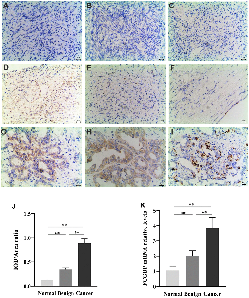 Expression of FCGBP in ovarian cancer tissues. (A–C) Representative images of immunohistochemistry showing FCGBP expression in normal ovarian tissues. (D–F) Representative images of immunohistochemistry showing FCGBP expression in benign ovarian cancer tissues. (G–I) Representative immunohistochemistry images showing FCGBP expression in ovarian cancer tissues. (J) IOD/area ratio of the indicated immunohistochemistry images. (K) qRT-PCR analysis of FCGBP expression in the indicated groups.