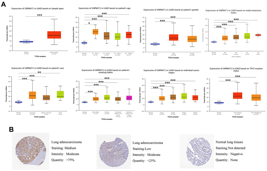 GNPNAT1 transcription and proteomics level in LUAD patients. (A) GNPNAT1 transcription level in normal and LUAD samples, and in subgroups of LUAD patients stratified by age, nodal metastasis, gender, race, smoking status, stage, and TP53 mutant status (UALCAN). The central mark is the median; the edges of the box are the 25th and 75th percentiles. The t-test was used to estimate the significance of difference in gene expression levels between groups. *, p p p B) Expression of GNPNAT1 in LUAD tumor specimens and normal specimens from the human protein profiles database (HPA).