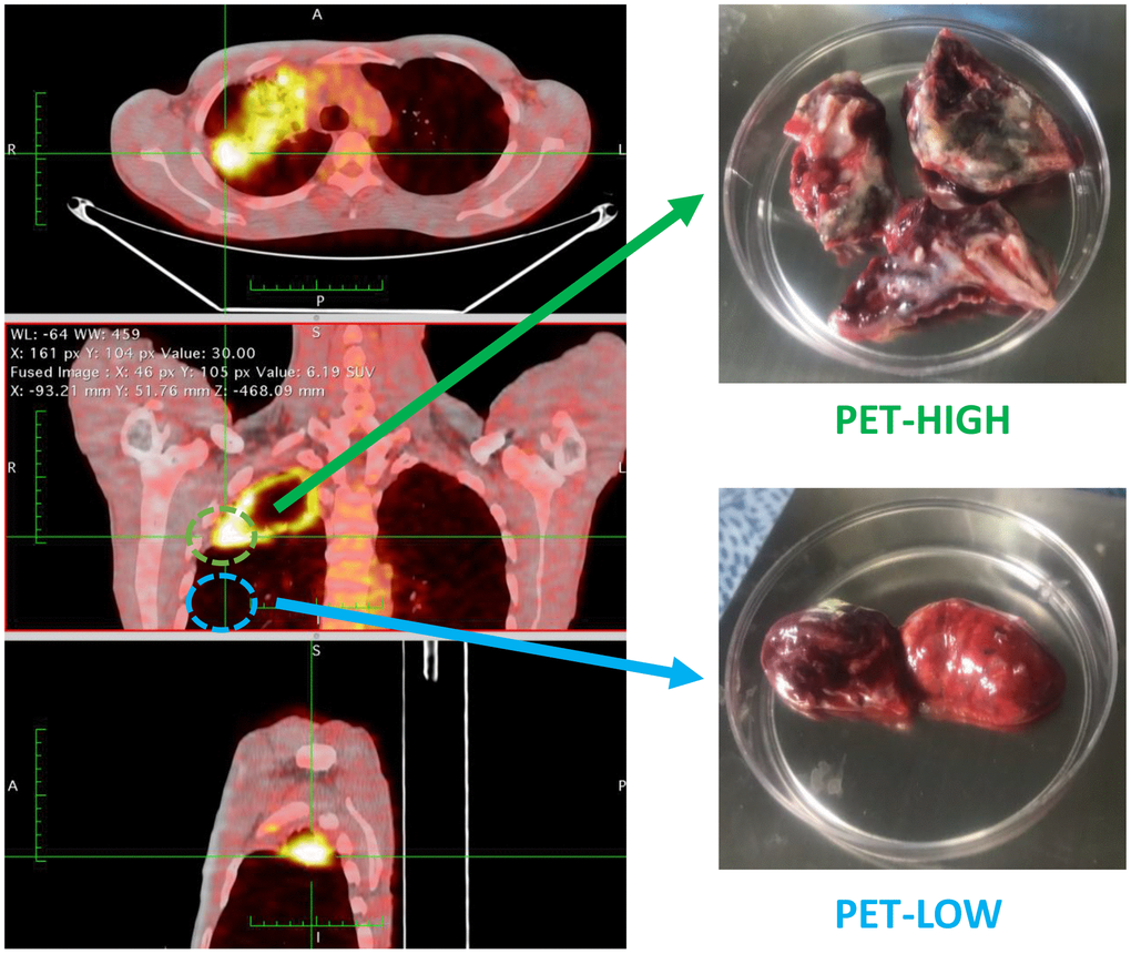 Lung tissue samples with high metabolic activity (PET-high) and low metabolic activity (PET-low) demonstrated by fluorine-18-fluorodeoxyglucose positron emission tomography combined with computed tomography (FDG-PET/CT) were collected for RNA-sequencing.