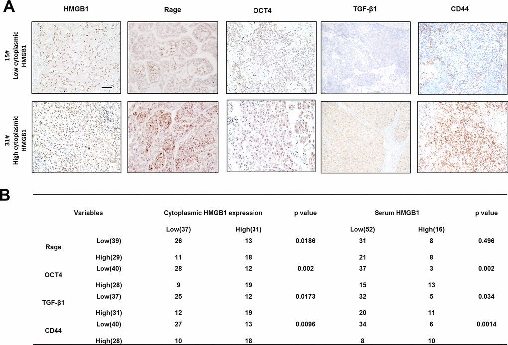 Correlation of related proteins in clinical HCC samples. (A) Representative images staining HMGB1, Rage, OCT4, TGF-β1 and CD44 in HCC samples. Scale bars, 100um. (B) Correlation of related proteins and cytoplasmic or serum HMGB1 in HCC samples. n=68. Data are means ± SEM, * means p