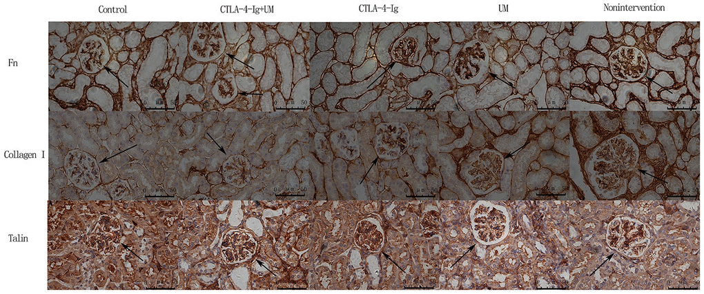 Analysis of renal Fn, collagen I, and talin staining. Analysis of renal Fn staining. Control group: Weakly positive Fn expression in the glomerulus (black arrow); CTLA-4-Ig + UM group: Positive Fn expression in the glomerulus (black arrow); CTLA-4-Ig group: Positive Fn expression in the glomerulus (black arrow); UM group: Strongly positive Fn expression in the glomerulus (black arrow); Non-intervention group: Strongly positive Fn expression in the glomerulus (black arrow). Analysis of renal Collagen I staining. Control group: Weakly positive Collagen I expression in the glomerulus (black arrow); CTLA-4-Ig + UM group: Weakly positive Collagen I expression in the glomerulus (black arrow); CTLA-4-Ig group: Weakly positive Collagen I expression in the glomerulus (black arrow); UM group: Positive Collagen I expression in the glomerulus (black arrow); Non-intervention group: Strongly positive Collagen I expression in the glomerulus (black arrow). Analysis of renal Talin staining. Control group: Strongly positive Talin expression in the glomerulus (black arrow); CTLA-4-Ig + UM group: Strongly positive Talin expression in the glomerulus (black arrow); CTLA-4-Ig group: Strongly positive Talin expression in the glomerulus (black arrow); UM group: Positive Talin expression in the glomerulus (black arrow); Non-intervention group: Positive Talin expression in the glomerulus (black arrow).