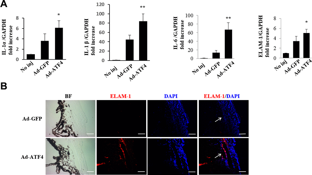 Activation of ATF4 mediates inflammatory cytokines expression in mice TM. (A) mRNA expression of inflammatory cytokines, IL-1α, IL-1β, IL-6 and ELAM-1 in the iridocorneal angle tissues of Ad-ATF4, Ad-GFP and no-injection group (No inj) was determined by real-time RT-PCR 3 days after injection (mean ± SEM, n = 4). ** PPB) Increased expression of ELAM-1 (red) was detected in the TM of the Ad-ATF4 group 7 days after anterior chamber injection (n = 3). Arrows mark the TM. Blue, nuclear staining with DAPI. BF, bright field. Scale bar, 50 μm.