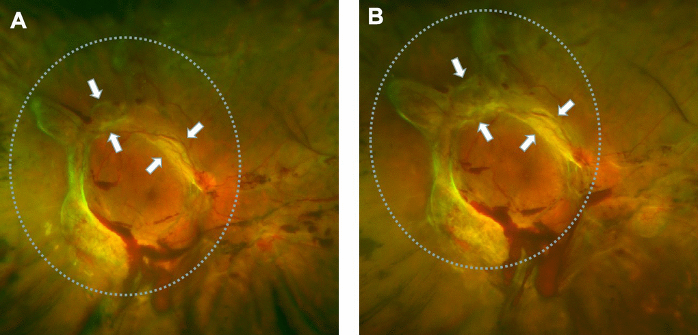 Retinal fibrosis accelerated after IVB treatment. (A) The fundus photograph shows pre-retinal hemorrhage and fibrosis in the macula and optic disc regions of the retina, a circular proliferative membrane presence before IVB treatment. (B) Retinal fibrosis was obviously accelerated post-IVB treatment. The arrows indicate the progression of pre-retinal membrane fibrosis compared to pretreatment conditions.
