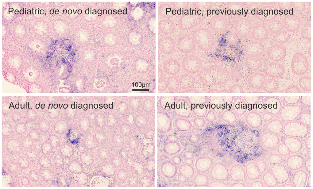 miR-21 ISH. Visual assessment of miR-21 expression (blue stain) in the rectal mucosa of 4 representative pediatric and adult UC patients. The miR-21 ISH signal is observed in relation to crypt abscesses. The miRNA expression by proportion of the region of interest: pediatric de novo diagnosed=0.079; pediatric previously diagnosed =0.023; adult de novo diagnosed=0.016; adult previously diagnosed=0.032. Sections were counterstained with nuclear fast red.