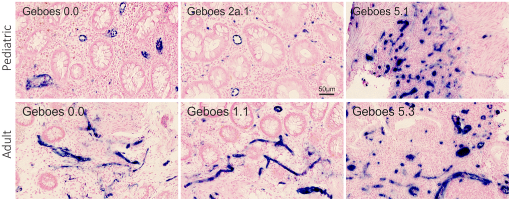 miR-126 ISH. Visual assessment of miR-126 expression (blue stain) in the rectal mucosa of 6 representative pediatric and adult UC patients with different Geboes scores. The miR-126 ISH signal is observed in relation to the vascular endothelial cells. The microRNA expression by proportion of the region of interest: top row from the left - 0.036, 0.024, and 0.22. Bottom row from the left - 0.025, 0.026, and 0.11.