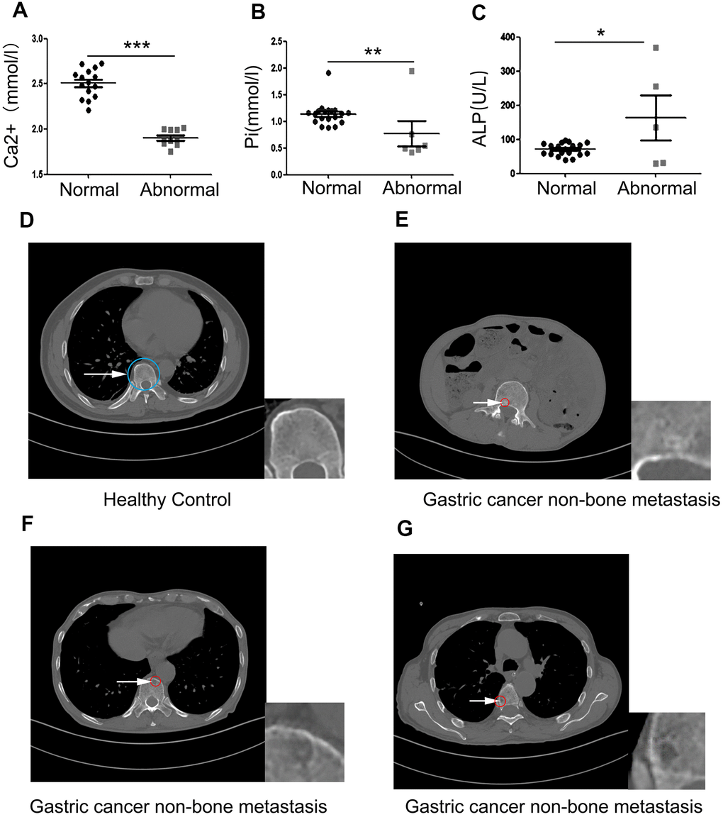 Clinical samples reveal that primary gastric cancer induces bone loss before bone metastasis occurs. (A–C) The concentration of serum Ca2+, Pi, and ALP in 25 non-bone metastatic gastric cancer patient compared to healthy volunteers. (D) Healthy control’s pyramidal computed tomography (CT). (E–G) Bone sections of three individual patients with non-bone metastatic gastric cancer. The insets are showing a high-power image of bone loss. The blue circle indicates normal bone and the white arrow pointing to the red circle indicates damaged bone. Data are shown as mean±SEM. Statistical differences are obtained using a Student's t-test, *, p