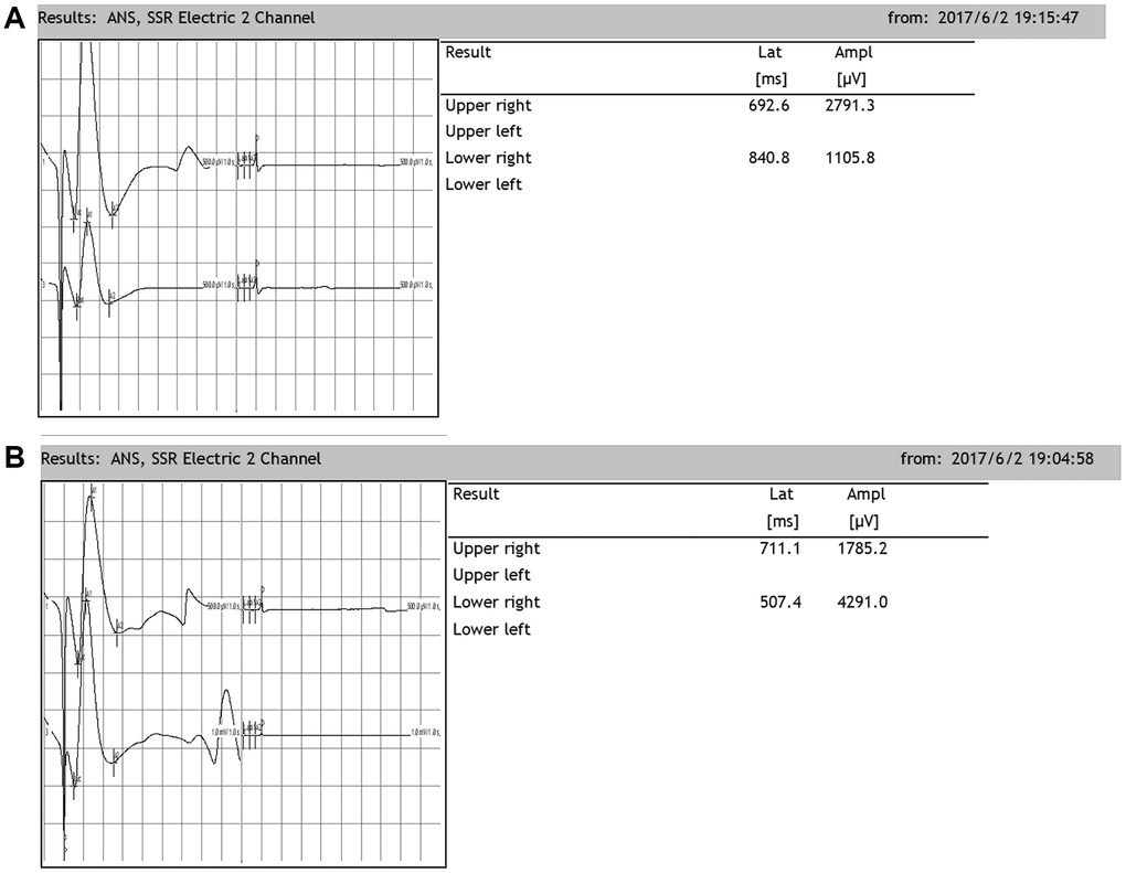 Representative sympathetic skin responses in normal rats. (A) We stimulated the left median nerve and recorded in the upper-right or lower-right limbs. (B) We stimulated the left tibial nerve and recorded in the upper-right or lower-right limb.