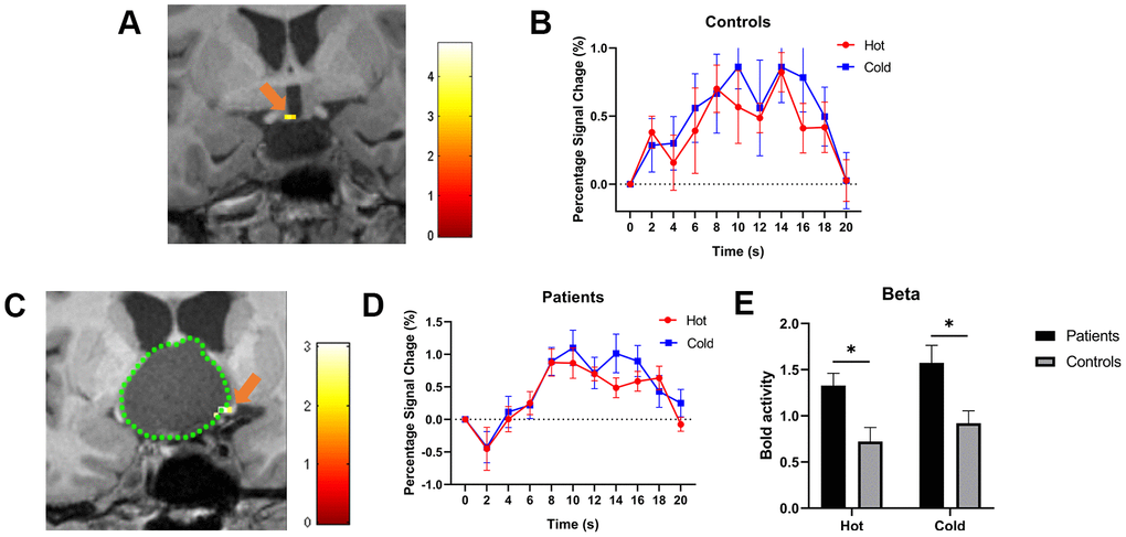 (A, C) show the activated POAH of the hypothalamus in an HV and a CP patient, respectively. The pseudo color indicates the t-value of the activation strength. The orange arrow indicated the activated POAH in the subject. In Figure 1C, the green dotted line was drawn to mark the boundary of the tumor. (B, D) show the BOLD responses to cold and warm stimuli in HVs and patients, respectively. (E) shows the beta values of warm and cold stimuli between patients and HVs. The BOLD activity in patients was significantly higher than that in HVs in response to both cold and warm stimuli. *: P