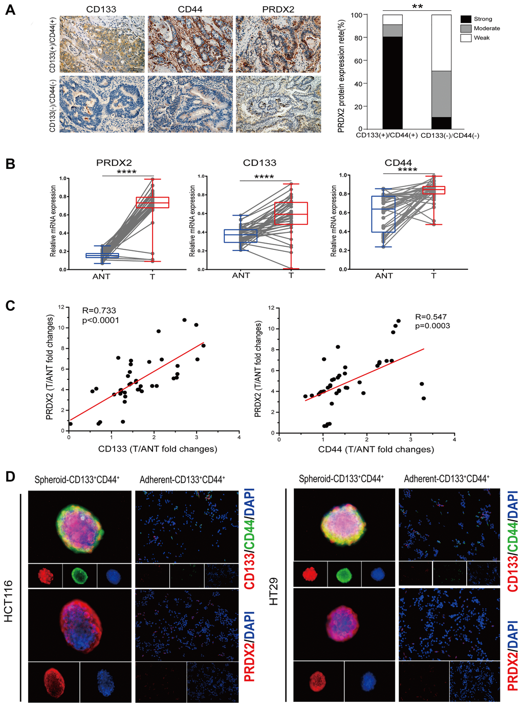 PRDX2 expression is closely associated with CD133+CD44+ CCSCs in colon cancer. (A) Left panel: Representative IHC images of CD133(+)/CD44(+) colon cancer tissues showing strong PRDX2 expression compared to CD133(-)/CD44(-) colon cancer tissues with weak PRDX2 expression. Right panel: Comparison of the proportions of PRDX2 expression in CD133(+)/CD44(+) colon cancer tissues (n = 9) and CD133(-)/CD44(-) colon cancer tissues (n = 10). Statistical analysis: Fisher’s exact test, **p B) Quantitation of PRDX2, CD44 and CD133 mRNA expression in 40 paired human colon tumor tissues (T) and matched adjacent noncancerous tissues (ANT) by real-time reverse transcription PCR analysis. Relative values were normalized to GAPDH. Statistical analysis: Paired t-test, ****p C) PRDX2 levels are correlated with CD133 and CD44 expression at the mRNA level. The data are presented as the fold changes in cancer specimens compared to matched adjacent noncancerous tissues. Statistical analysis: Nonparametric Spearman correlation analysis (R value) was performed. (D) Immunofluorescence analysis of PRDX2 expression and the coexpression of CD133 and CD44 in spheroid CD133+CD44+ CCSCs and adherent CD133-CD44- cells isolated from HCT116 and HT29 cell lines, respectively.