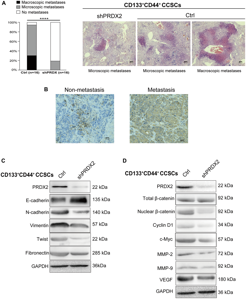 PRDX2 knockdown inhibits the metastatic capacity of CCSCs. (A) Histological analysis of the liver for metastatic lesions was performed by hematoxylin and eosin staining. The metastatic status of the mice (n = 16 per group) with orthotopic implantation of 1 × 104 cells dissociated from HCT116/HT29-control or -shPRDX2 CD133+CD44+ CCSCs is provided separately as macroscopic (black) and microscopic (gray) evidence for metastasis (left panel). Statistical analysis: Fisher’s exact test, ***p +CD44+ CCSCs and a mouse receiving shPRDX2-HCT116-CD133-CD44- CCSCs (right panel). (B) Representative IHC staining for PRDX2 reveals that higher PRDX2 expression was detected in the orthotopic tumor tissues from metastatic cases than in tumor samples from nonmetastatic mice. (C) Western blot analysis of EMT protein expression in lysates of control- and shPRDX2-CD133+CD44+ CCSCs. (D) Western blot analysis of Wnt/β-catenin signaling pathway protein expression in lysates of control- and shPRDX2-CD133+CD44+ CCSCs.