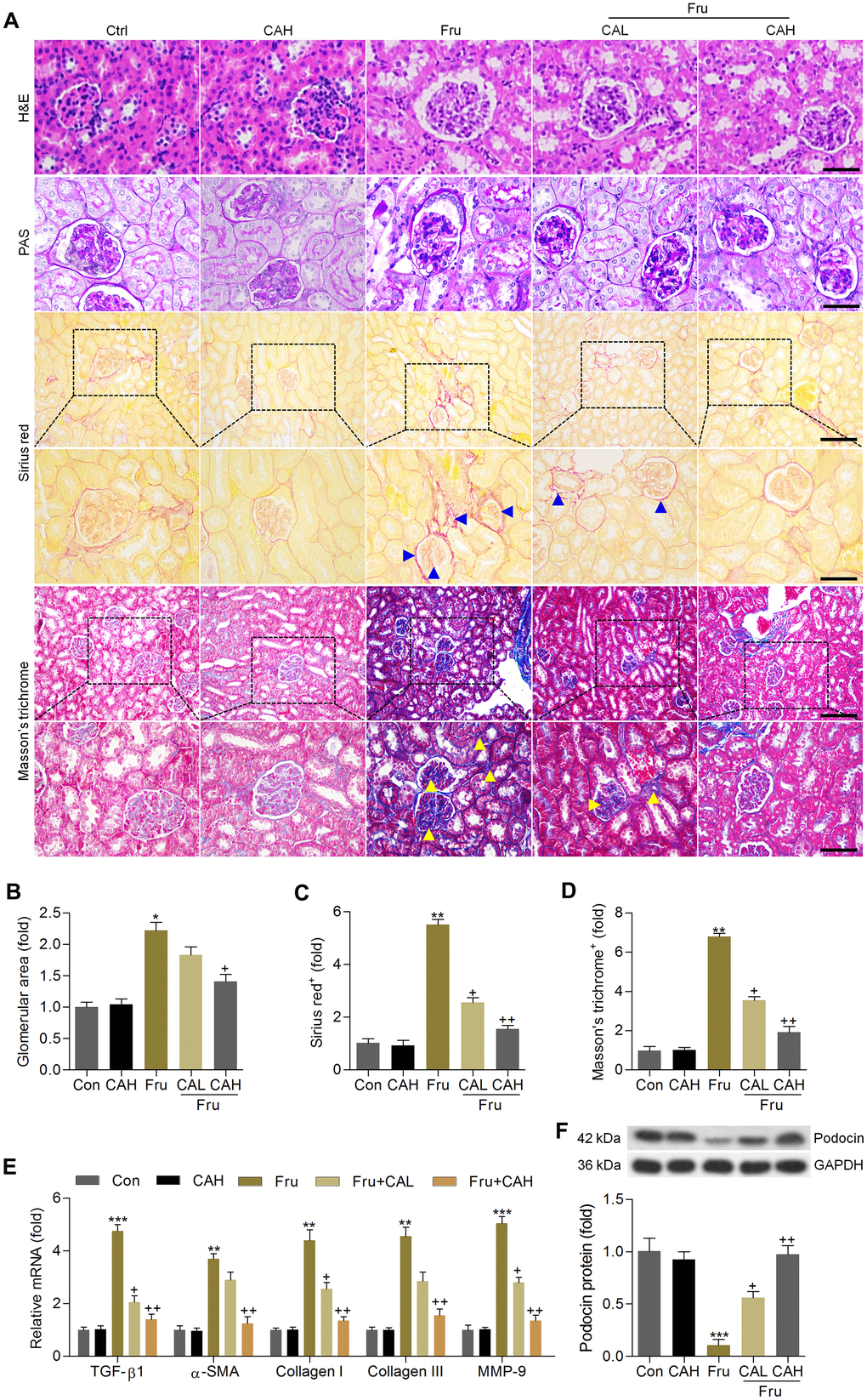 Carminic acid attenuates the pathological symptoms in the Fru-induced chronic renal injury. (A) H&E (Scale bar = 50 μm), PAS (Scale bar = 50 μm), Sirius red (blue arrow: collagen accumulation; Up panel, Scale bar = 100 μm; Down panel, Scale bar = 50 μm) and Masson’s trichrome (yellow arrow: collagen accumulation; Up panel, Scale bar = 100 μm; Down panel, Scale bar = 50 μm) staining of renal sections for the calculation of histological changes. (B) Glomerular area was quantified. Calculation of fibrosis condition following (C) Sirius red and (D) Masson’s trichrome staining. (E) RT-qPCR analysis for fibrotic genes in renal tissues. (F) Western blot analysis of podocin in kidney samples. The results are expressed as the means ± SEM. n = 4 in each group.*P**P***P+P++P