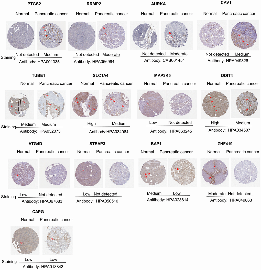 Differences in protein expression of the key genes in pancreatic cancer tumor tissue and normal tissue from Human Protein Atlas immunohistochemistry.