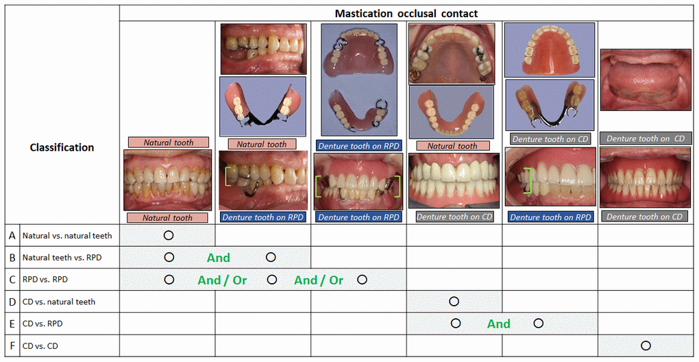 Mastication classifications and occlusal contact. RPD design varies depending on the number of missing teeth and classification B, C, and E include multiple scheme of occlusal contact pattern.